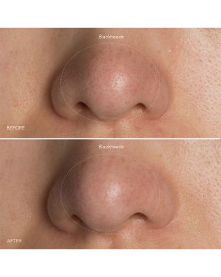 KIWI Blackhead Remover