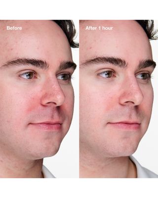 Acne Solutions Clinical Advanced Clearing Gel 0.34 oz.