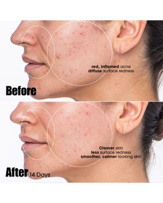 Peacekeeper Acne Treatment Serum 1 oz.