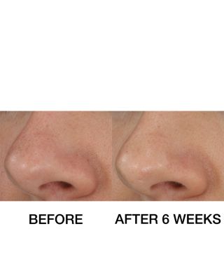 Blackhead Solutions Self-Heating Blackhead Extractor 0.7 oz.