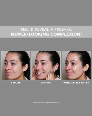 FIRMx Peeling Gel 3.4 oz.