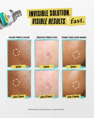 Truly Targeted Acne Clearing Solution with Salicylic Acid 0.5 oz.