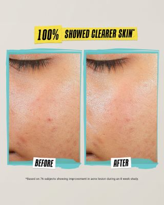 Expertly Clear Acne Treating & Preventing Lotion 2 oz.