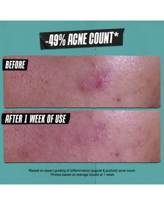 Gently Effective Acne Treating Cleansing Paste 4.2 oz.