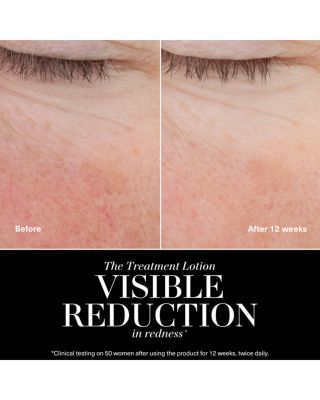 The Treatment Lotion 8.5 oz.