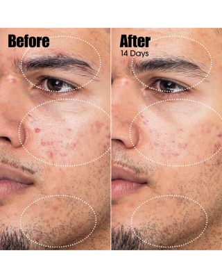 Peacekeeper Acne Treatment Serum 1 oz.