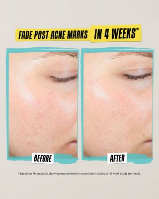 Expertly Clear Acne Treating & Preventing Lotion 2 oz.