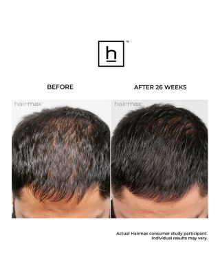 LaserBand 41 ComfortFlex Hair Growth Device