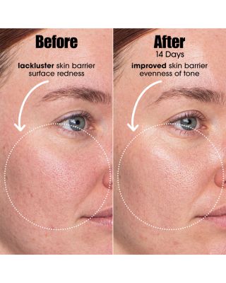 AI Smart Retinoid Serum for Blemish Prone Skin 1 oz.