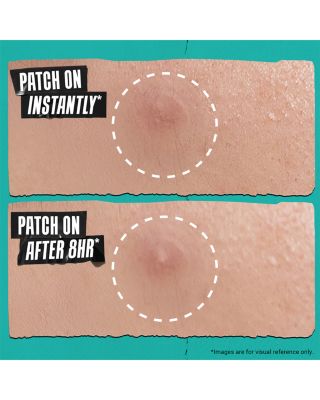 Truly Targeted Overnight Blemish Patch