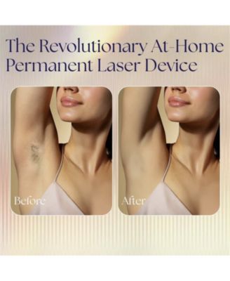  Laser Hair Removal Device