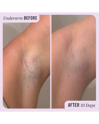 Ingrown Hair Pads with BHA & AHA