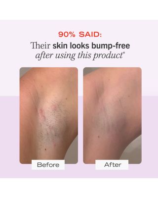 Ingrown Hair Pads with BHA & AHA