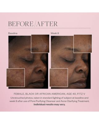 Acne Clarifying Treatment 2 oz.