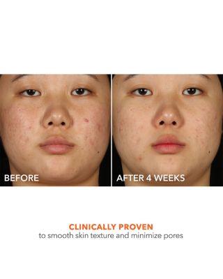 Alpha Beta 2% BHA+ Breakout Solution 5 oz.