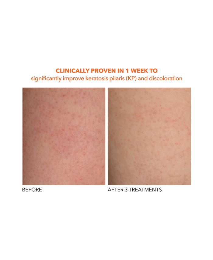 Alpha Beta® Exfoliating Body Treatment