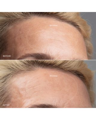 KIWI Microdermabrasion & Pure Vacuum