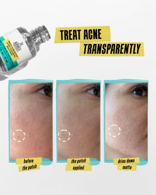 Truly Targeted Acne Clearing Solution with Salicylic Acid 0.5 oz.