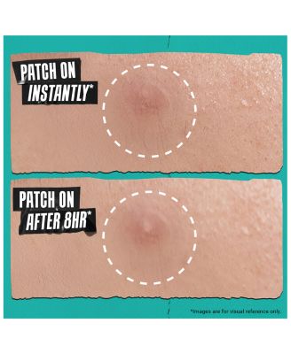 Truly Targeted Overnight Blemish Patch