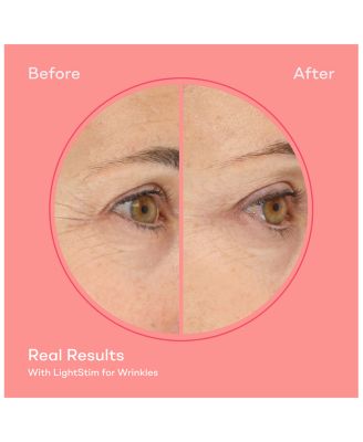 LightStim for Wrinkles