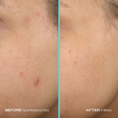 Facial Radiance Pads with Glycolic & Lactic Acids Exfoliating Pads with AHA