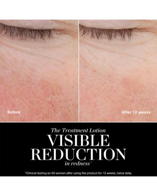 The Treatment Lotion 5 oz.