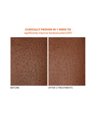 Alpha Beta&reg; Exfoliating Body Treatment