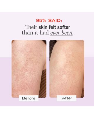 KP Bump Eraser Body Scrub with 10% AHA - Body Exfoliant for Keratosis Pilaris 8 oz.