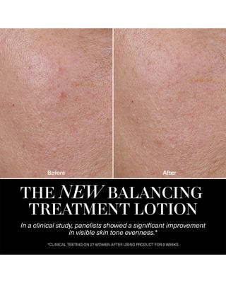 The Balancing Treatment Lotion 5.1 oz.