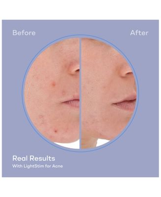 LightStim for Acne