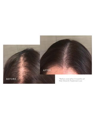 Flourish Hair Growth Treatment Set