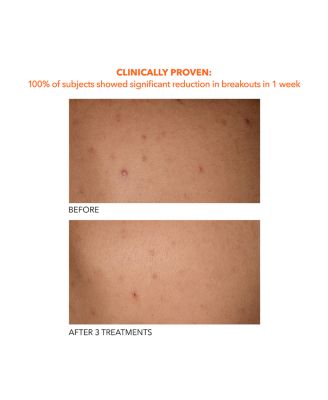 Alpha Beta&reg; Exfoliating Body Treatment